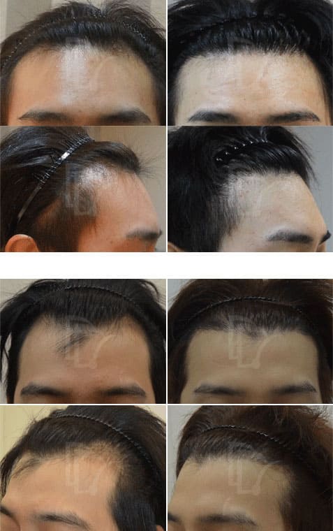男性脱发