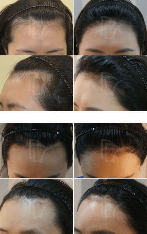 女性ヘアライン